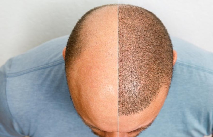 كم سنة تدوم عملية زراعة الشعر وما هي مخاطر عمليات زراعة الشعر