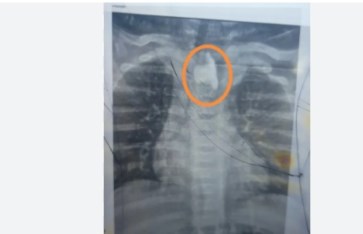 استخراج زلطة من مريء طفل