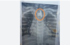 استخراج زلطة من مريء طفل