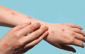 فيروس جدري القردة